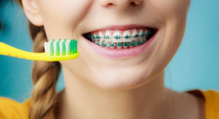 7 Tips for Maintaining Your Oral Health While Wearing Braces